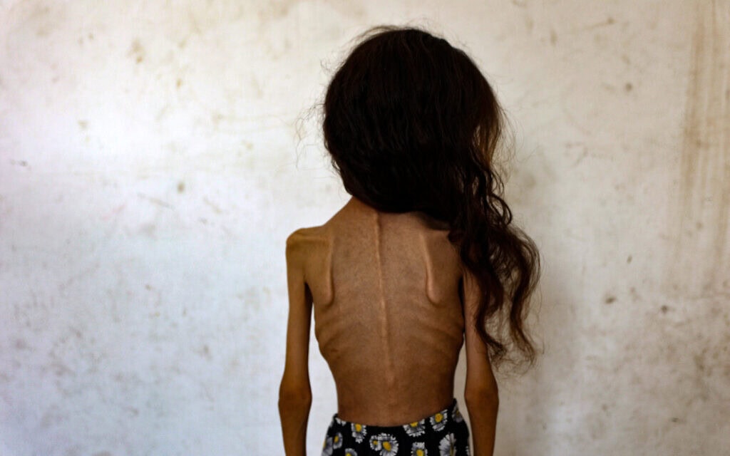 מרים דוואס, ילדה פלסטינית בת 9 הלוקה בתת־תזונה, בשכונת רימאל בעיר עזה, 2 באוגוסט 2025 (צילום: Omar AL-QATTAA / AFP) מרים דוואס, ילדה פלסטינית בת 9 הלוקה בתת־תזונה, בשכונת רימאל בעיר עזה, 2 באוגוסט 2025 (צילום: Omar AL-QATTAA / AFP)